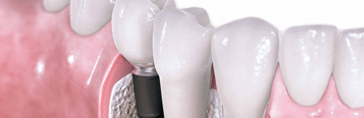 DENTALNI IMPLATANTI PODGORICA